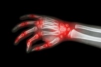 bones joints pain hands ageing arthritis stockdevil