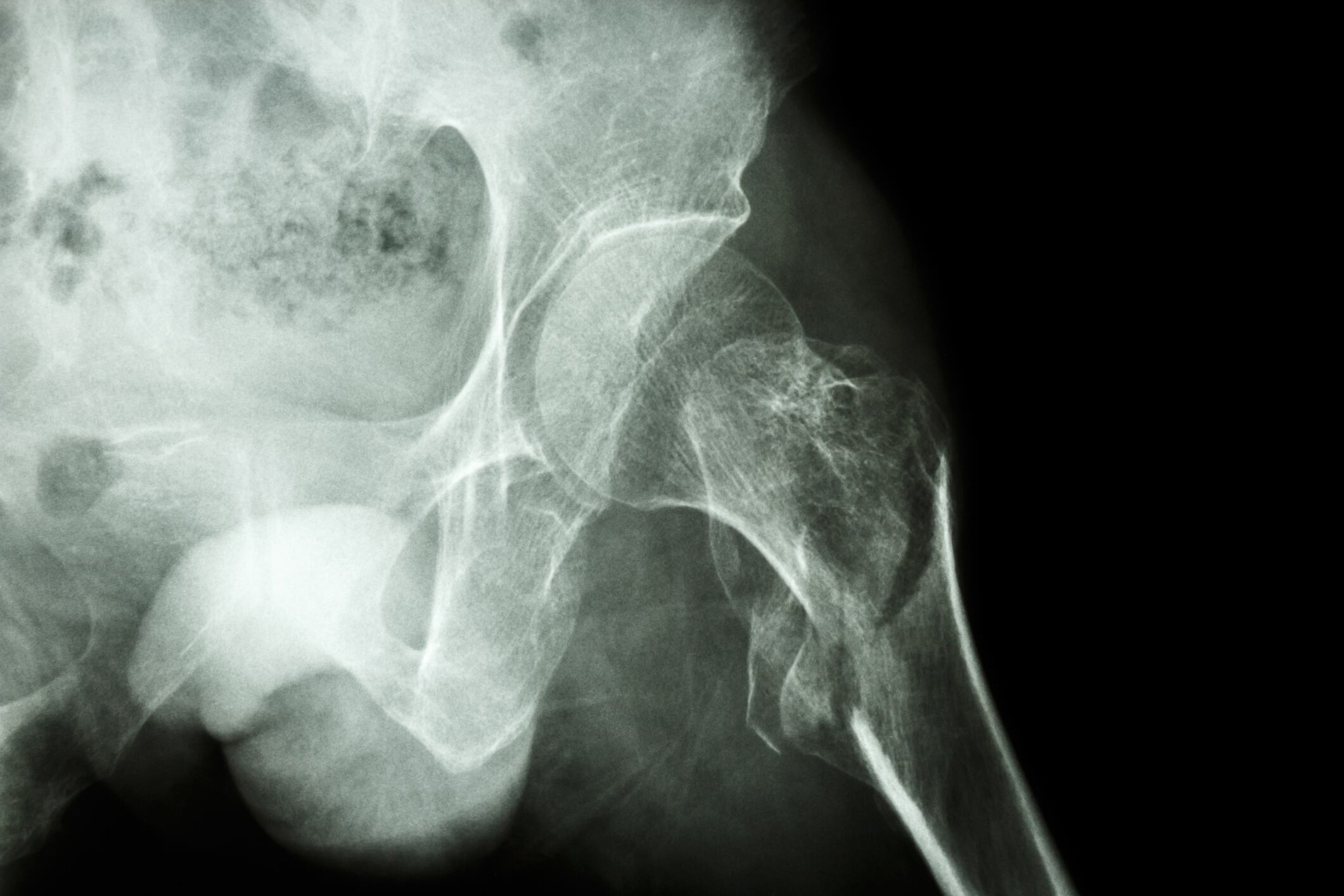 Probiotics to prevent bone loss? Study reveals candidate strain for bone health