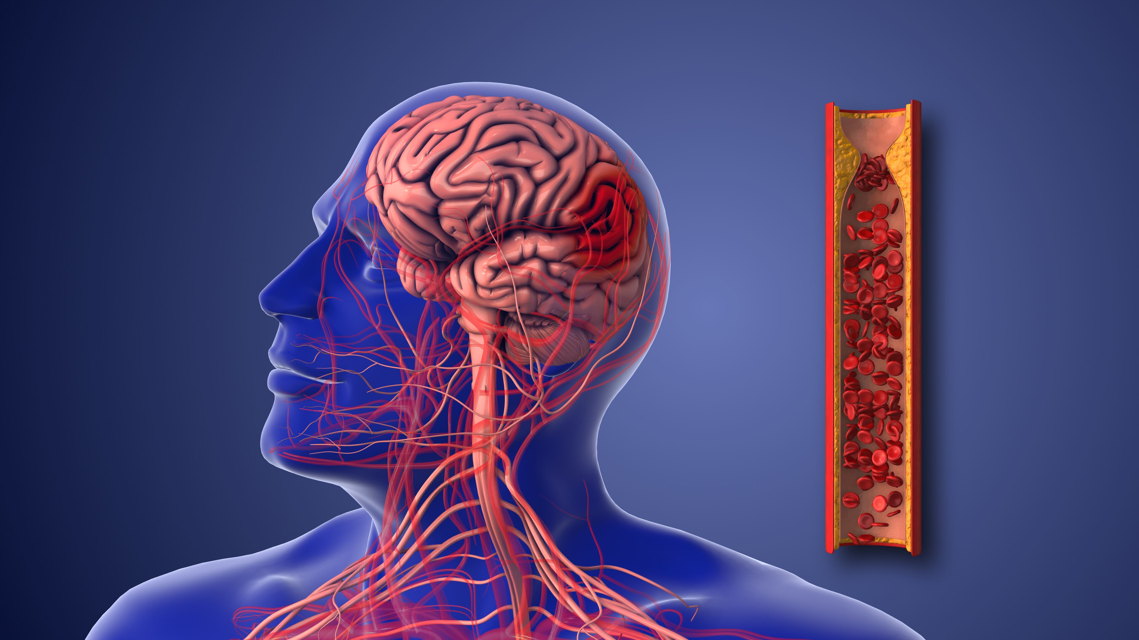 Most ischemic strokes are caused by atherosclerosis, which is also called hardening of the arteries. Atherosclerosis happens when fat and cholesterol build up in your arteries, or blood vessels, causing your arteries to narrow. Over time, this can completely block blood flow.