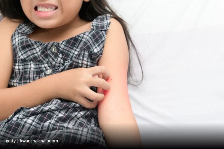 Vitamin-D-may-help-reduce-eczema-in-early-infancy.jpg
