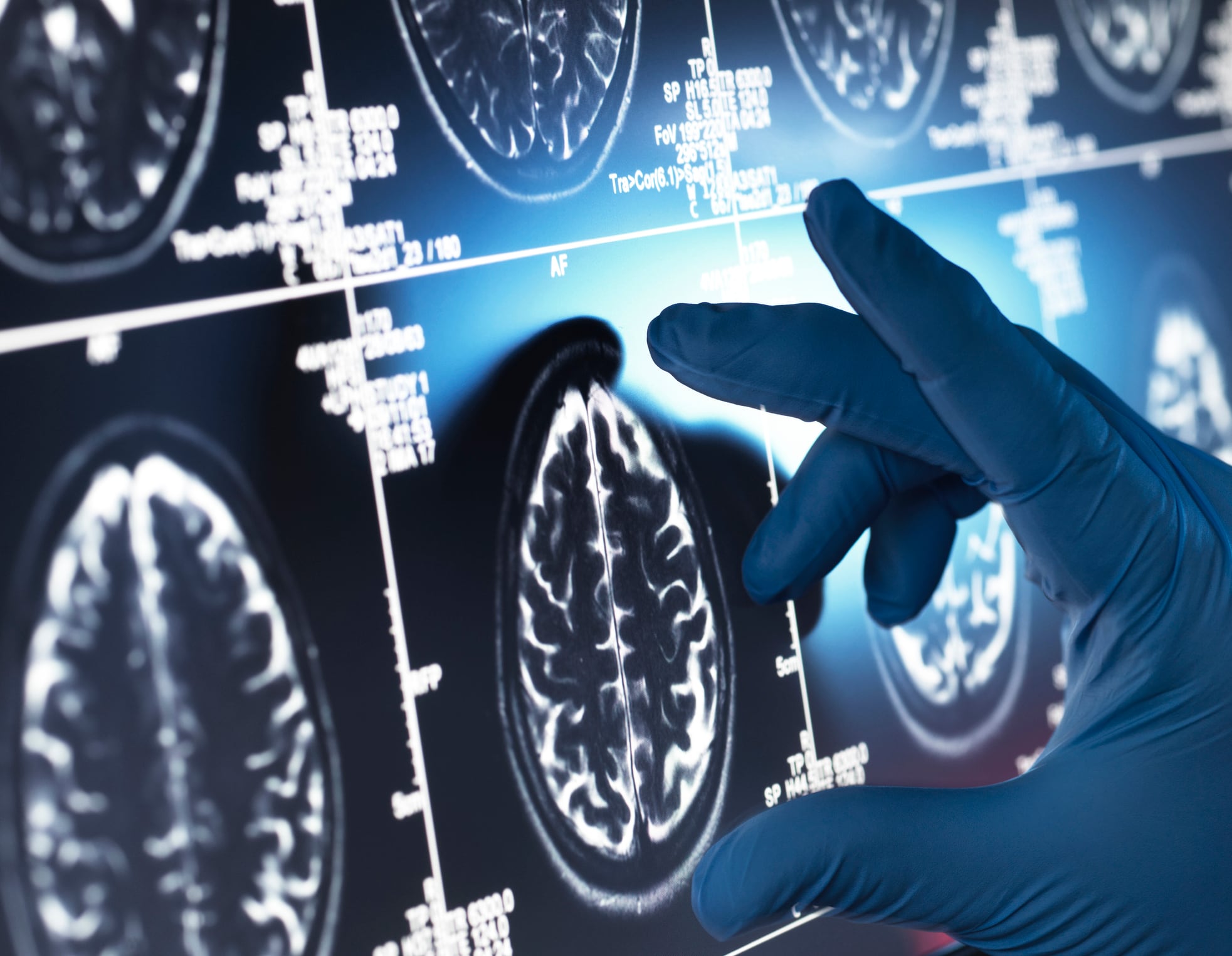 "My interpretation at this stage is that glucosamine supplementation is not a key driver for dementia although it may amplify a pathology in motion in some cases," said Mark JS Miller, PhD, MBA of Kaiviti Consulting, LLC.