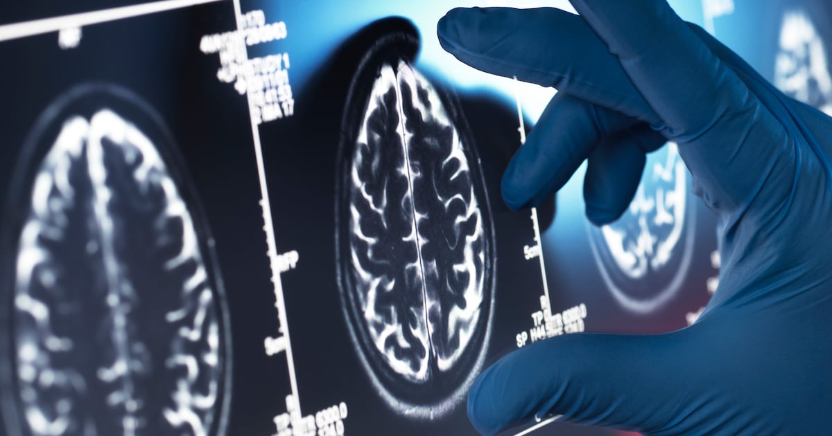 Industry questions glucosamine-Alzheimer’s risk findings