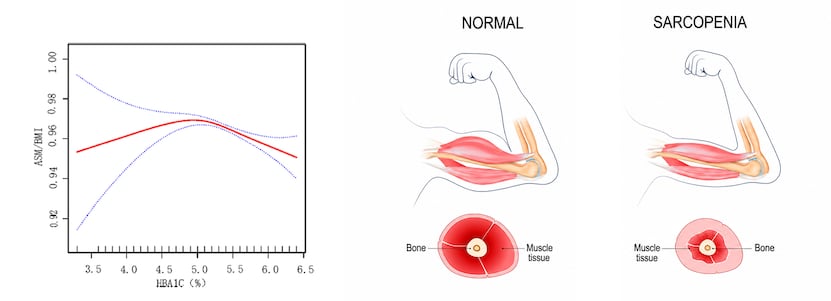 Normal muscle vs sarcopenia