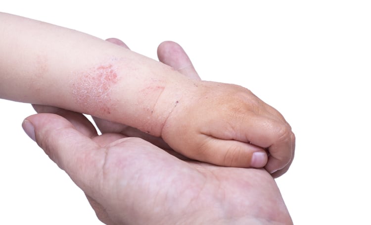 Probiotics and infant eczema: Maternal supplementation of Lactobacillus, Bifidobacterium appears beneficial – meta-analysis