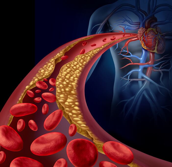 cardiovascular-heart-health-blood-cholesterol-clogged-iStock.com-wildpixel.jpg