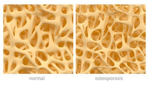 Osteoporosis.jpg