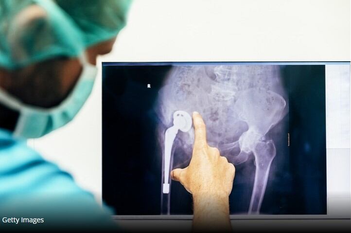 Vitamin D does not lower fracture risk in adults, study finds
