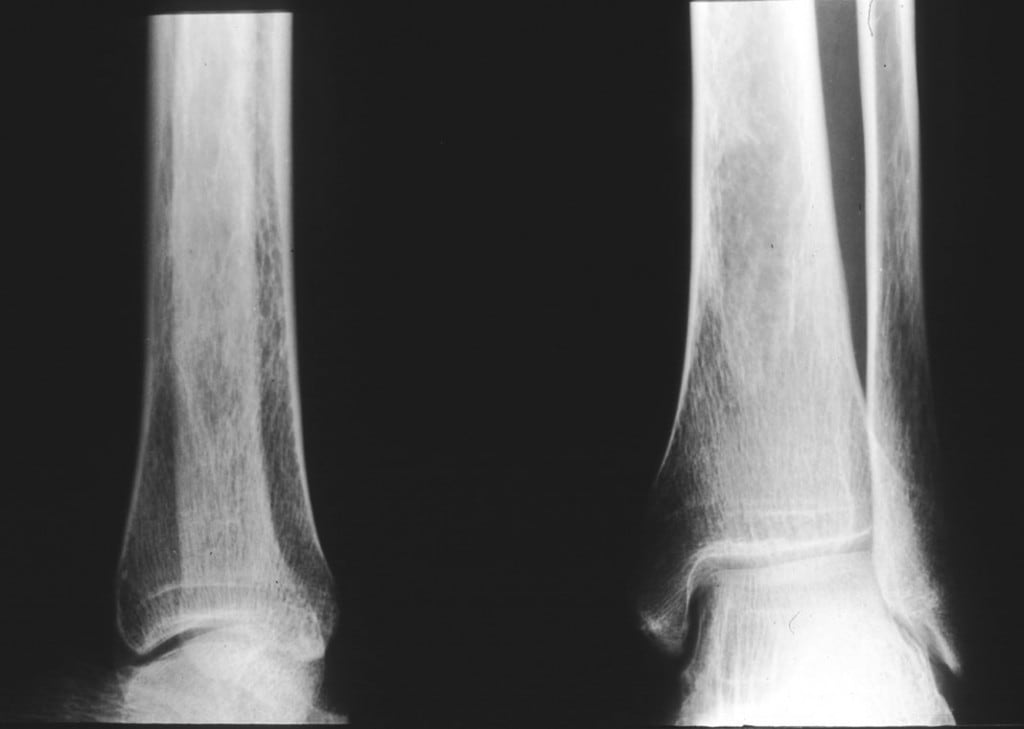 bone-density.jpg