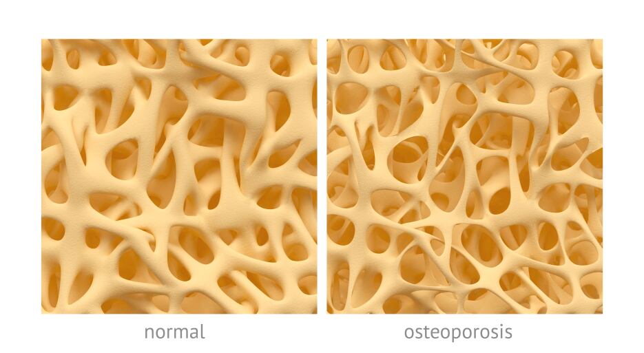 Probi-backed trial identifies probiotic blend’s link to reduced bone loss in women