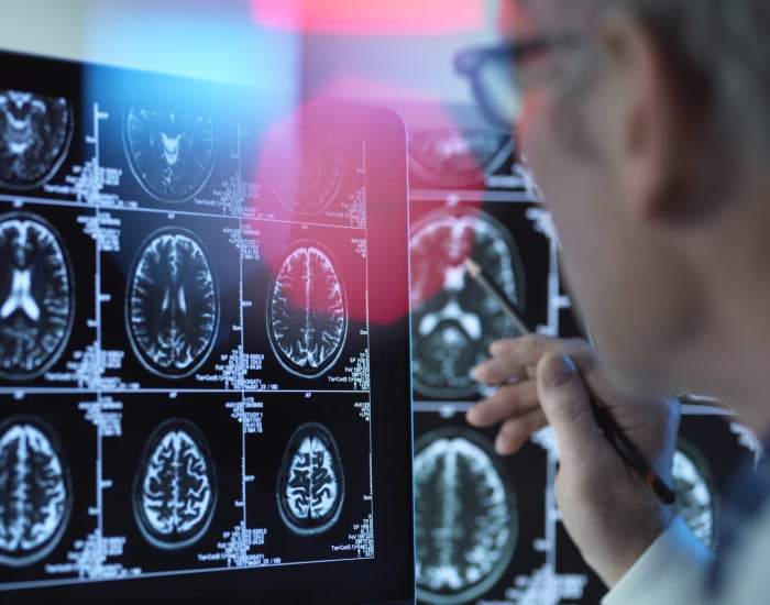Review suggests vitamin K2 may help prevent Alzheimer’s