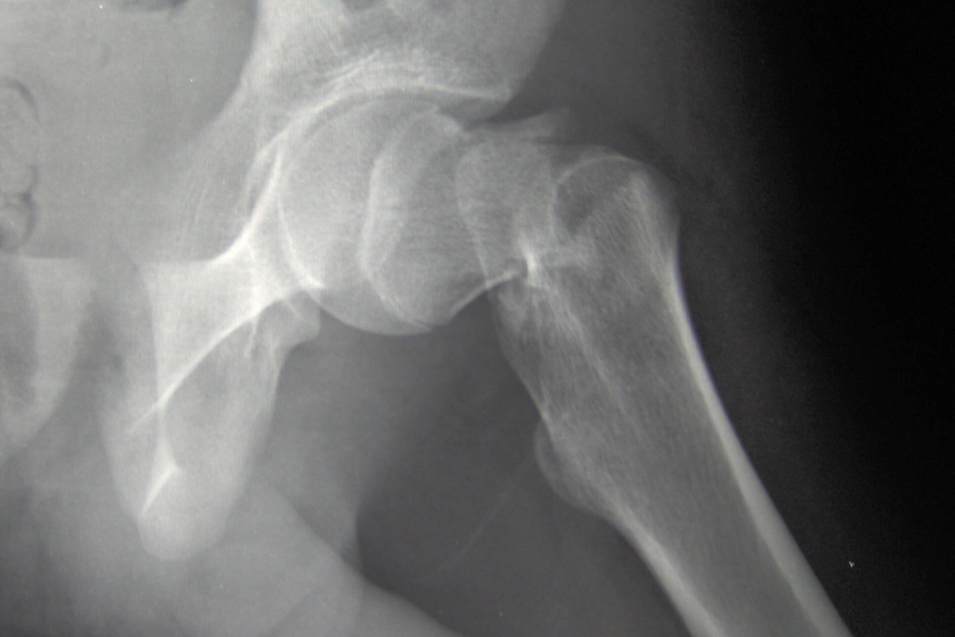 Too much vitamin A linked to bone fracture risk: Mouse data