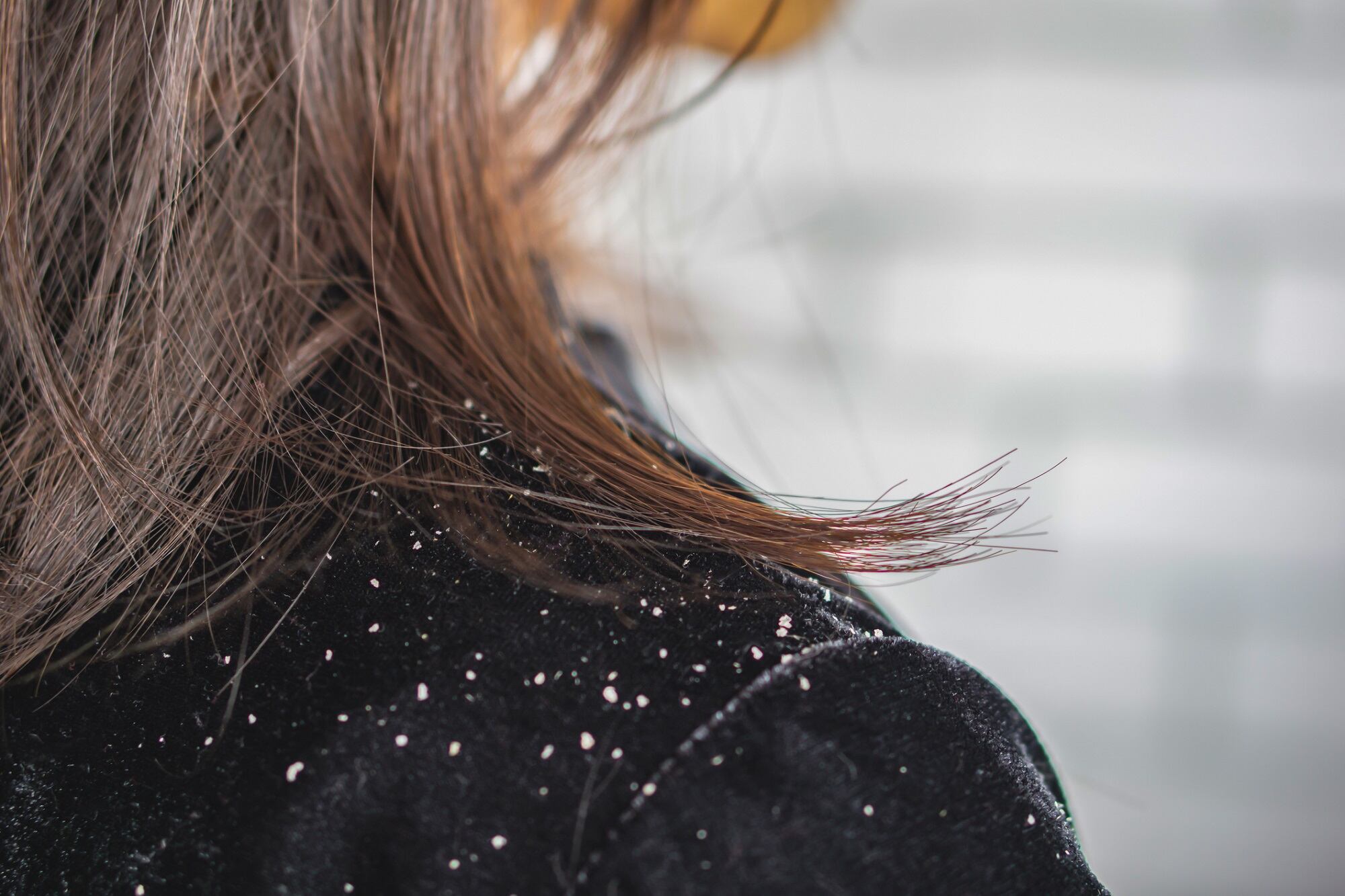 Paraprobiotic shampoo 'stands out' in decreasing dandruff, improving scalp appearance