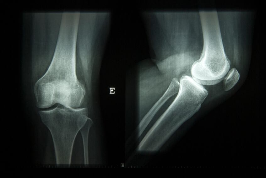 bone-health-joints-x-ray-iStock.com-raalves.jpg