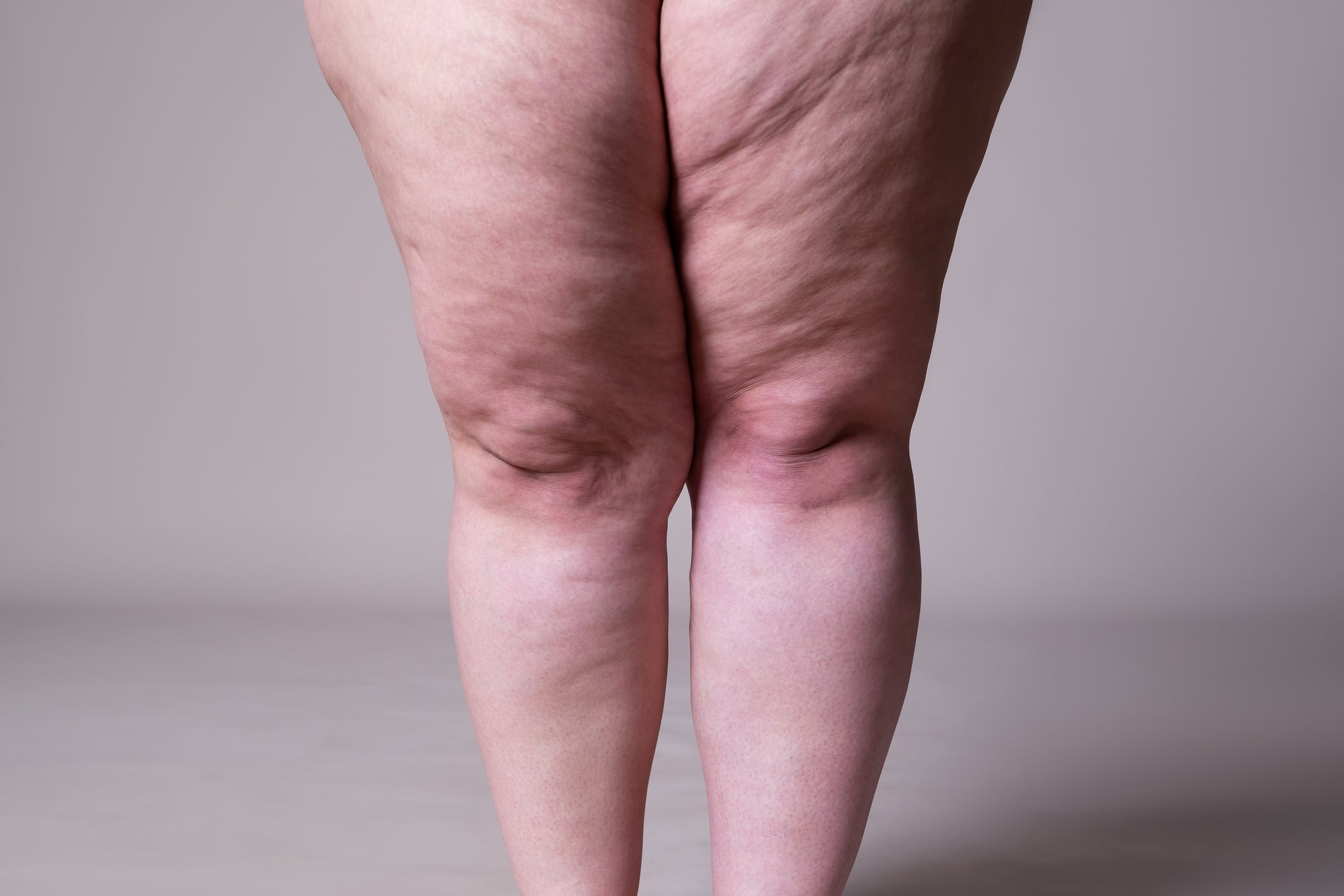 Researchers-deliver-a-verdict-on-supplementation-in-managing-lipedema.jpg