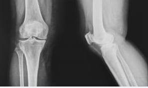 Eggshell membrane improves joint functionality in knee osteoarthritis, study shows