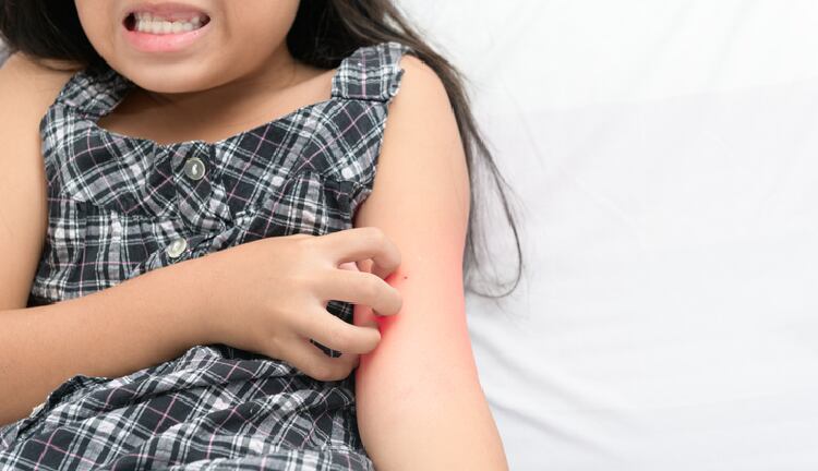 Intake of yogurt containing L. lactis improves atopic dermatitis – Japan trial