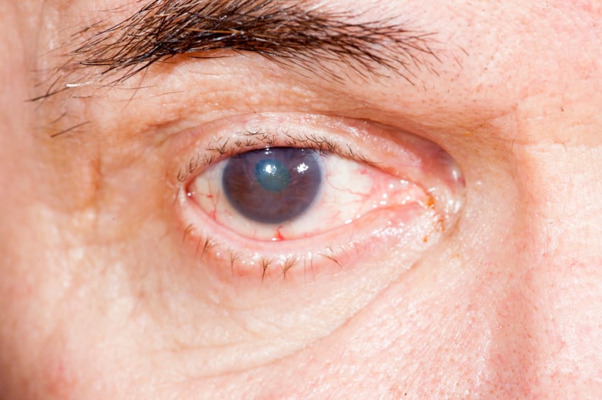 Meta-analysis-links-vitamins-and-carotenoids-with-lower-risk-of-age-related-cataract.jpg