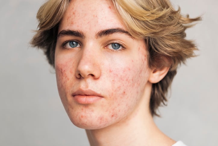 man-with-acne.jpg