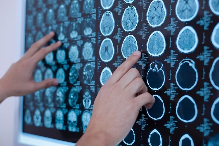 Parexel-Biotech-conducting-Ph-IIa-neurodegenerative-disease-trial.jpg