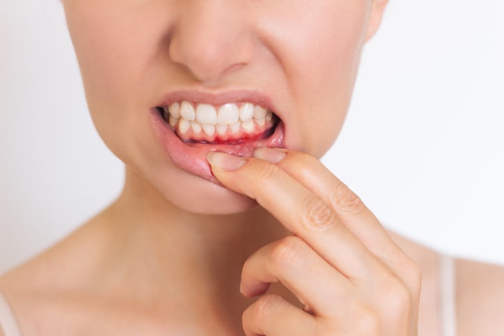 Study-Probiotics-aid-gum-inflammation-recovery.jpg