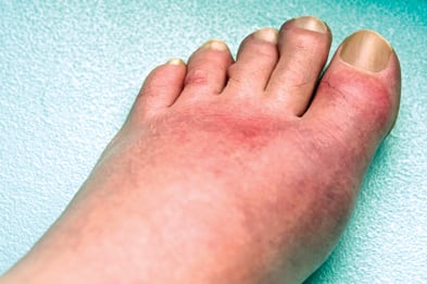 gout.jpg