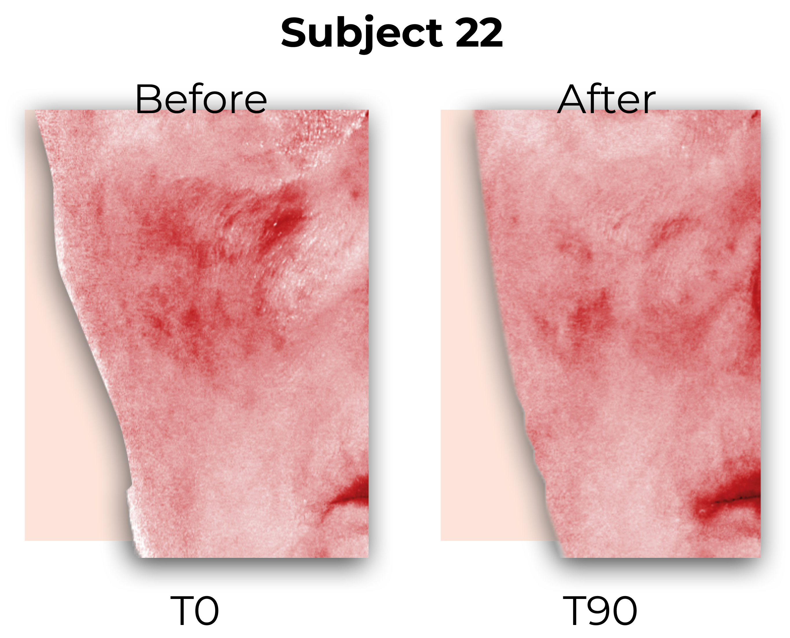 Before & after study images of patient with rosacea who took a dietary supplement with rose and melon