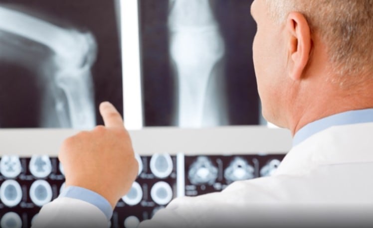 Study attempts to answer if gut bacteria plays rheumatoid arthritis role