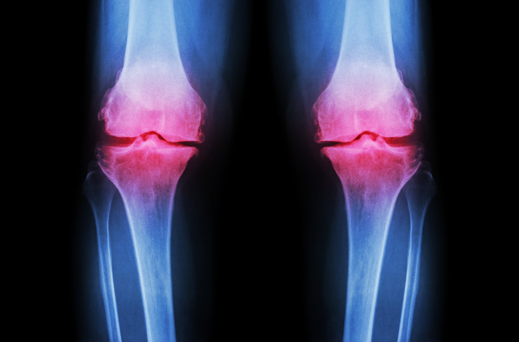 RCT supports eggshell membrane’s joint health benefits