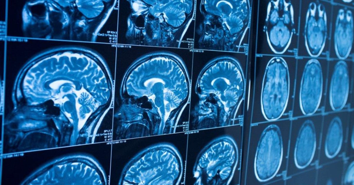 Inside the menopausal brain: Heights launches MRI study into nutrition and cognitive health