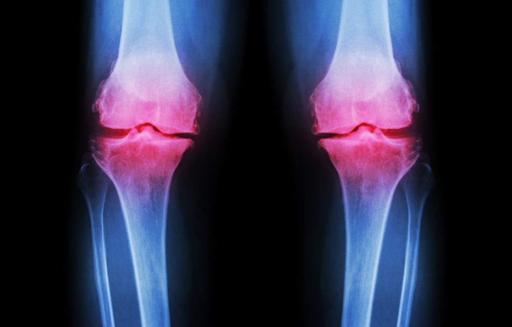 Bioiberica partners with ByHealth to enhance joint health range