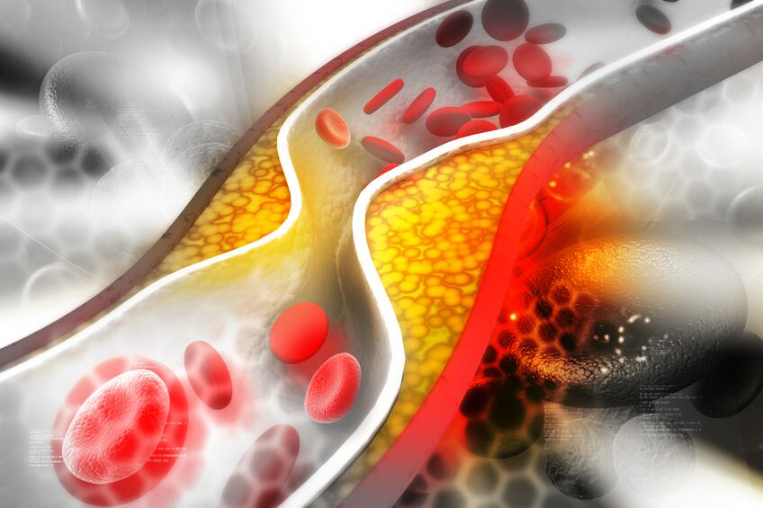 cholesterol-heart-cardiovascular-disease-iStock-HYWARDS.jpg
