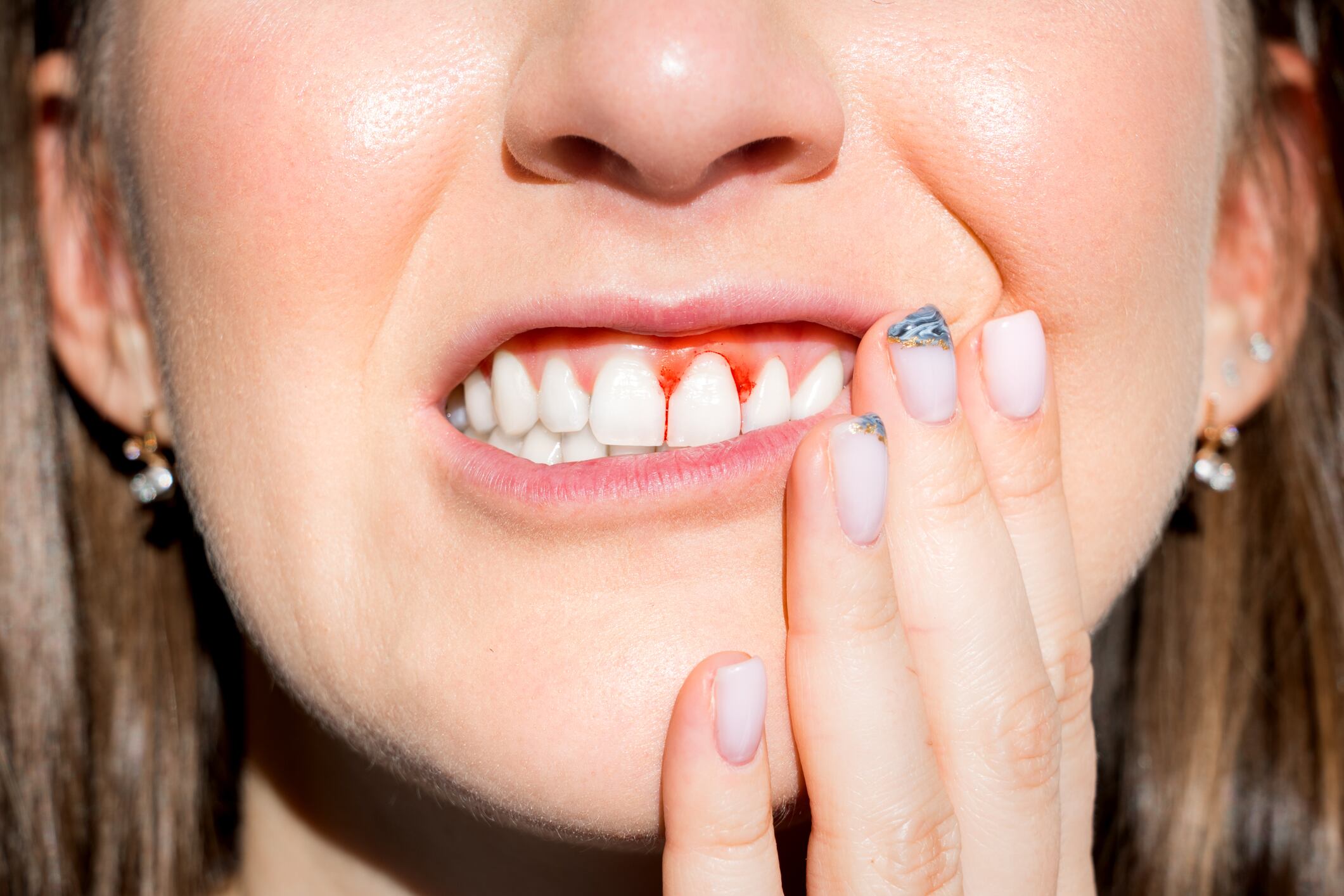 Gingivitis is the inflammation of the gums and occurs when microbial plaque accumulates on the tooth surface due to ineffective tooth brushing.