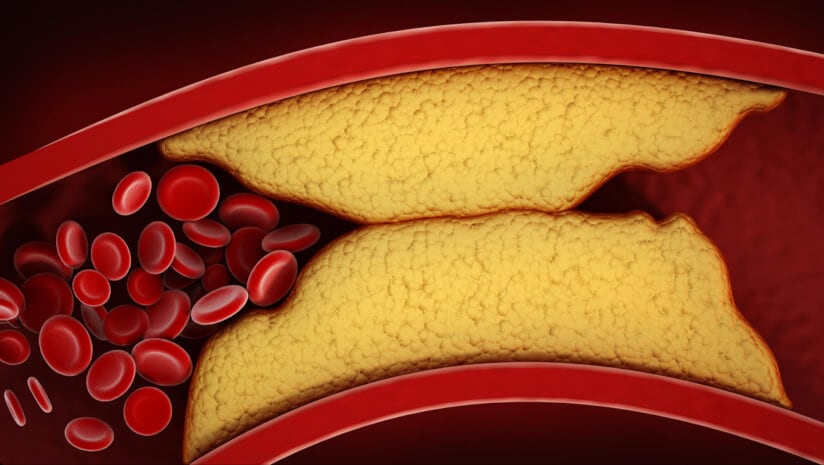 A visualization of thickened arteries and veins, coronary heart disease. High cholesterrol blocks the vein preventing blood circulation within the vascular system.