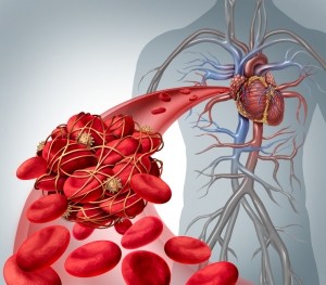 blood clot stroke cardiovascular heart iStock wildpixel