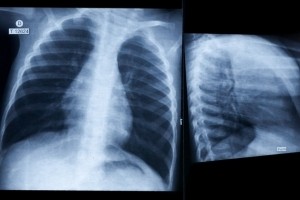 xray chest lungs