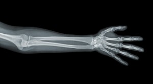 arm x-ray bones calcium vitamin D