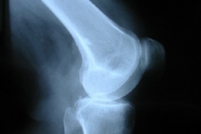 Study finds calcium fructoborate lessens knee pain