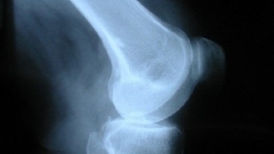 Glucosamine plus chondroitin sulphate may aid joint health in osteoarthritis