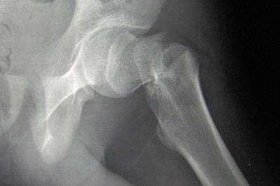 Bone Xray hip fracture skeleton