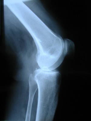 Bone and joint health - a growing market