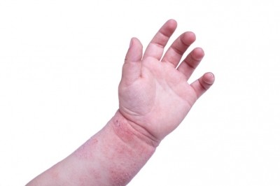 The cause of eczema is largely unknown but is thought to be a combination of genetic and environmental factors.©iStock/taborsk