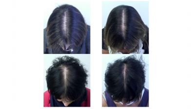 Effect of a nutritional supplement on hair loss in women