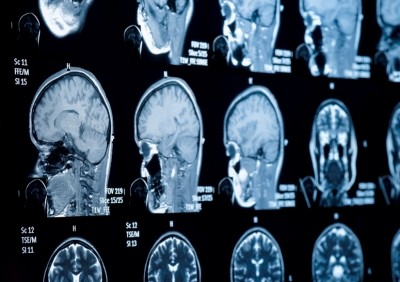 The modified complexes were particularly effective in destroying brain cancer cells. ©iStock