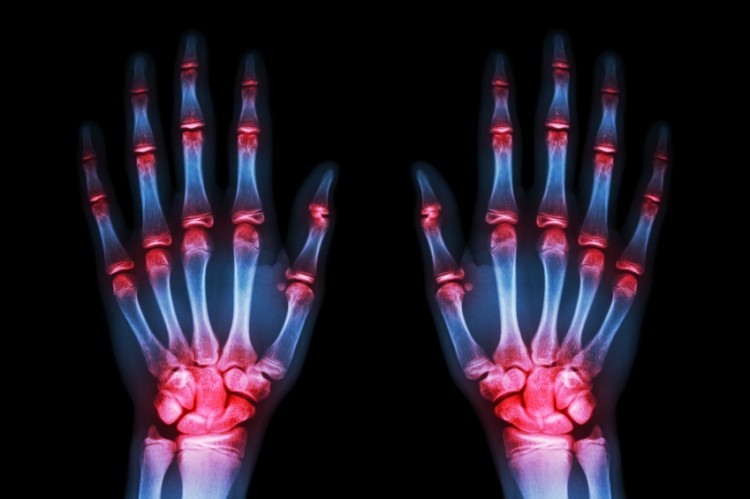 Company claims glucosamine and chondroitin sulphate supplement can relieve pain for “almost 80% of osteoarthritis sufferers”. © iStock.com / stockdevil