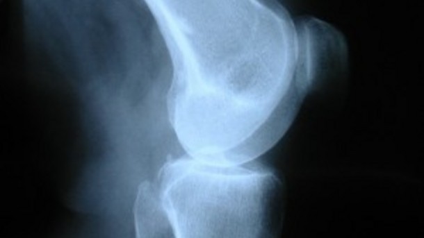 RCT data backs supplement for joint pain benefits