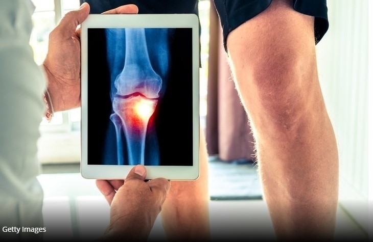 Study finds collagen peptides reduce knee joint discomfort