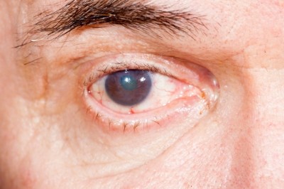 In Europe, a rough approximation of cataract rates in adults in 2007 was 19.3%. © iStock.com / sdigital