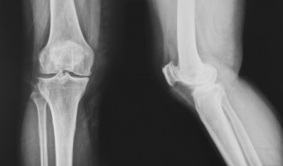 Dietary fatty acids backed for osteoarthritis protection: Mouse data