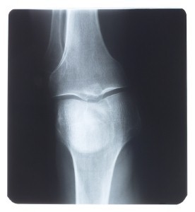 High-dose vitamin D backed for fractures: Meta-analysis