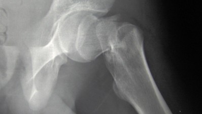 Magnesium may protect against hip fractures: Study